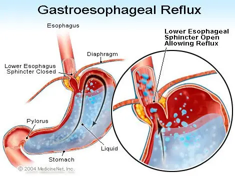 Illustration of gastroesophageal reflux disease (GERD)
