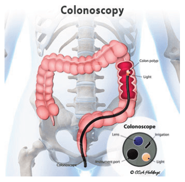 Colonoscopy and endoscopy illustration