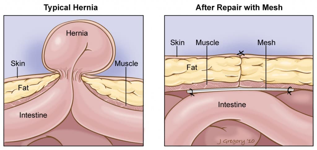 Hernia repair